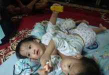 Agista Ali Mazi Ikut Bantu Pengobatan Bayi Kembar Siam di Kendari