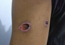 Satu Lagi Mahasiswa Kendari Mengaku Kena Peluru Tajam